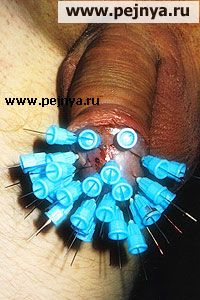 Иглоукалывание